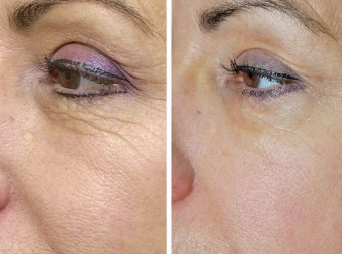 Terenski laser pred in po njem